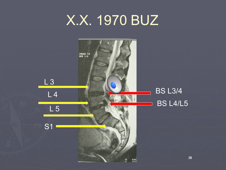 X.X BUZ L 3 BS L3/4 L 4 BS L4/L5 L 5 S1 28