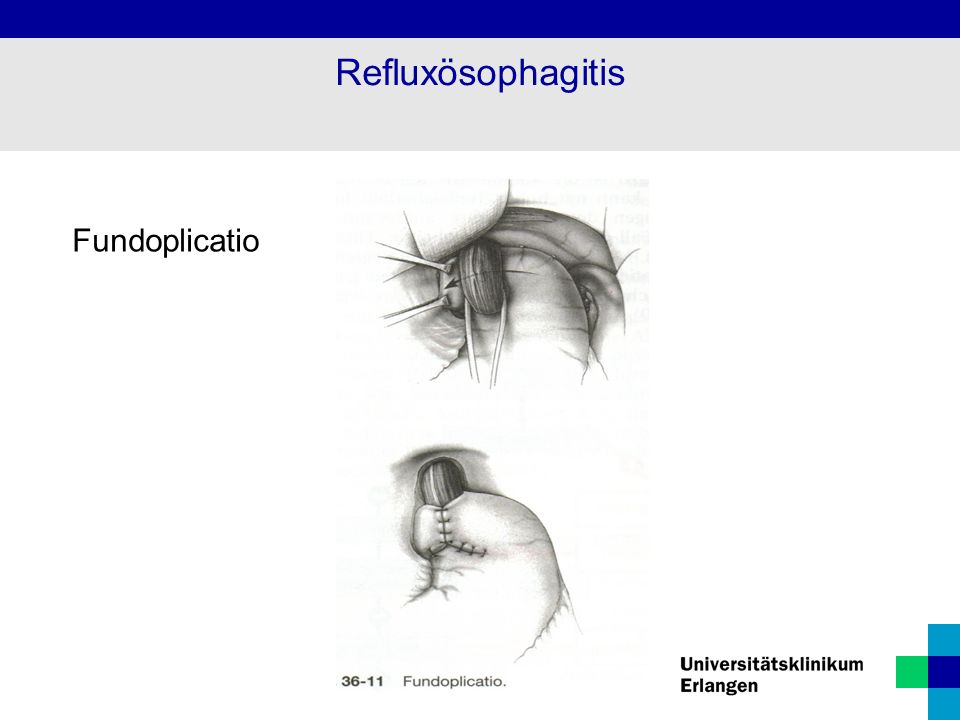 Refluxösophagitis Fundoplicatio