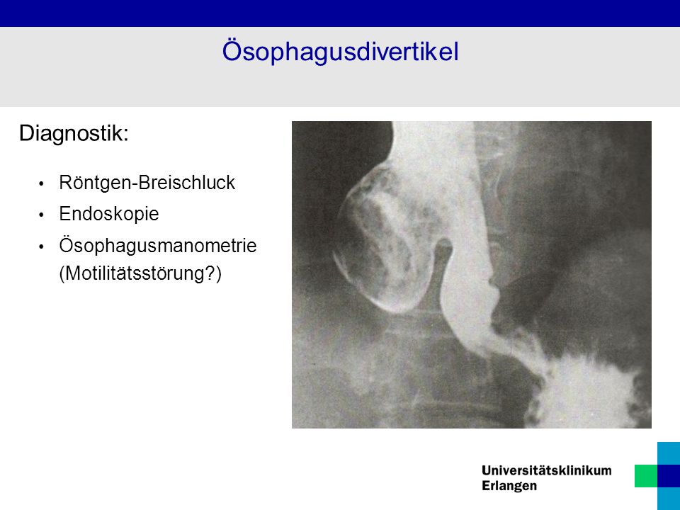 Ösophagusdivertikel Diagnostik: Röntgen-Breischluck Endoskopie
