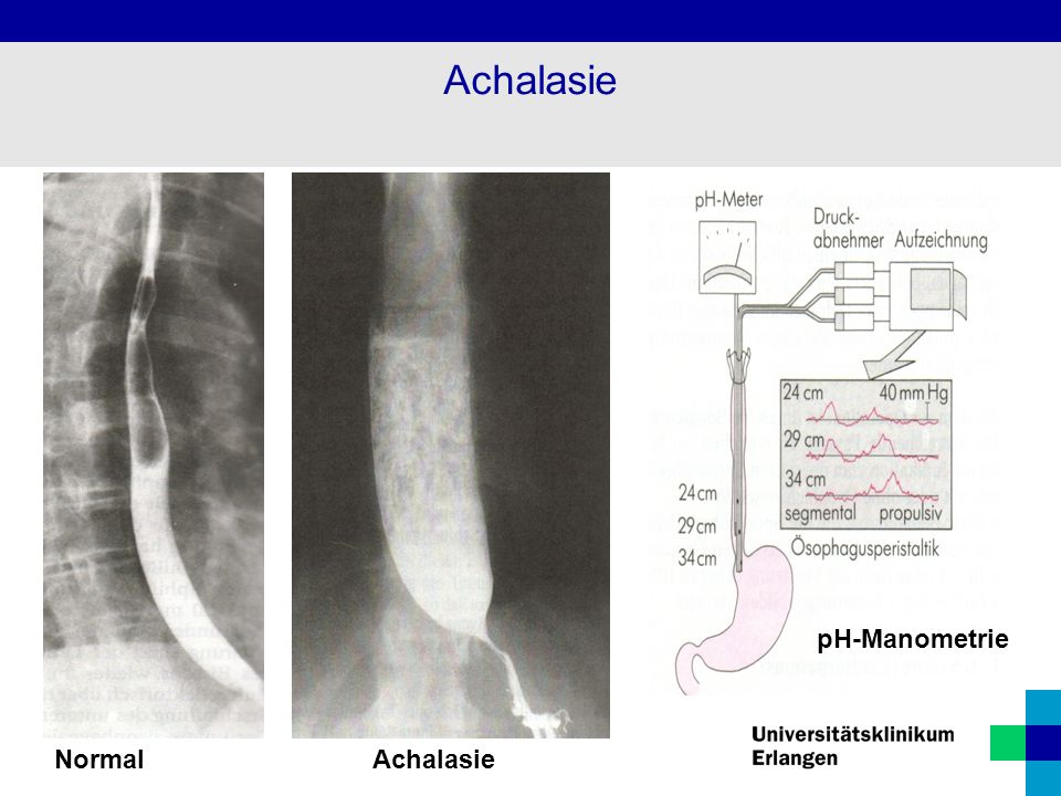 Achalasie pH-Manometrie Normal Achalasie