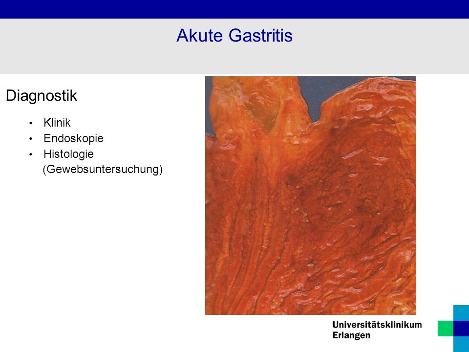 Akute Gastritis Diagnostik Klinik Endoskopie Histologie