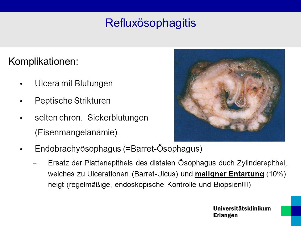 Refluxösophagitis Komplikationen: Ulcera mit Blutungen