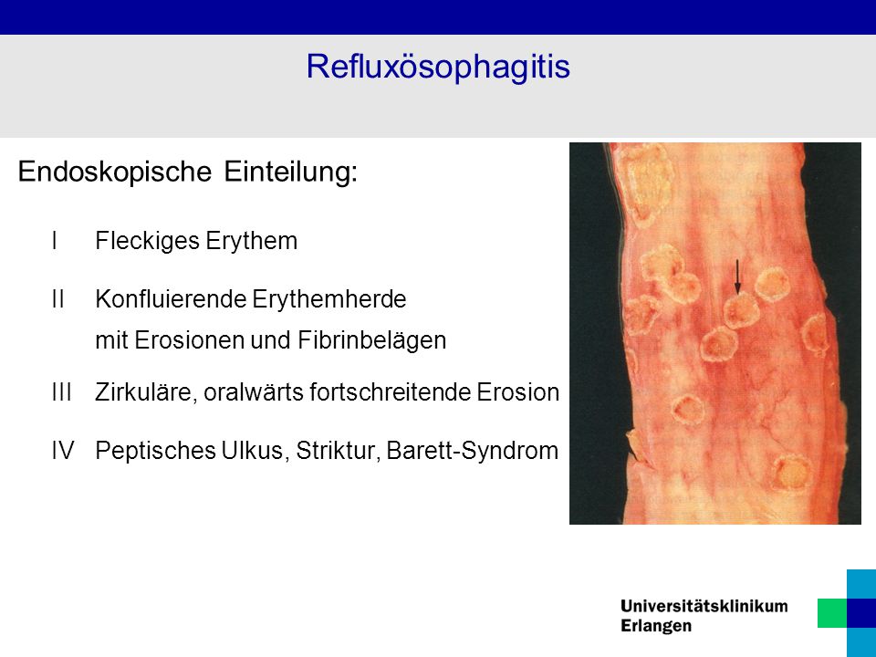 Refluxösophagitis Endoskopische Einteilung: I Fleckiges Erythem
