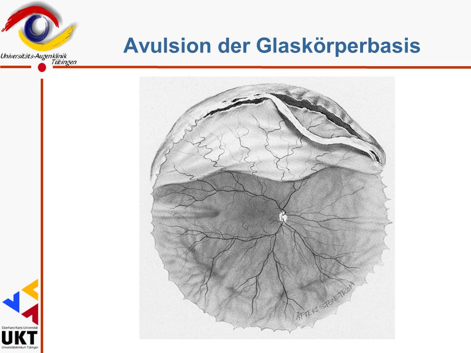 Avulsion der Glaskörperbasis