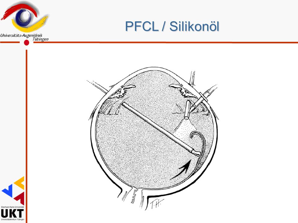 PFCL / Silikonöl Erst alles besser 1987 durch PFCL, Entfaltung von unten Vitrektomie. Zivojnovic in Rotterdam und Haut in Paris.