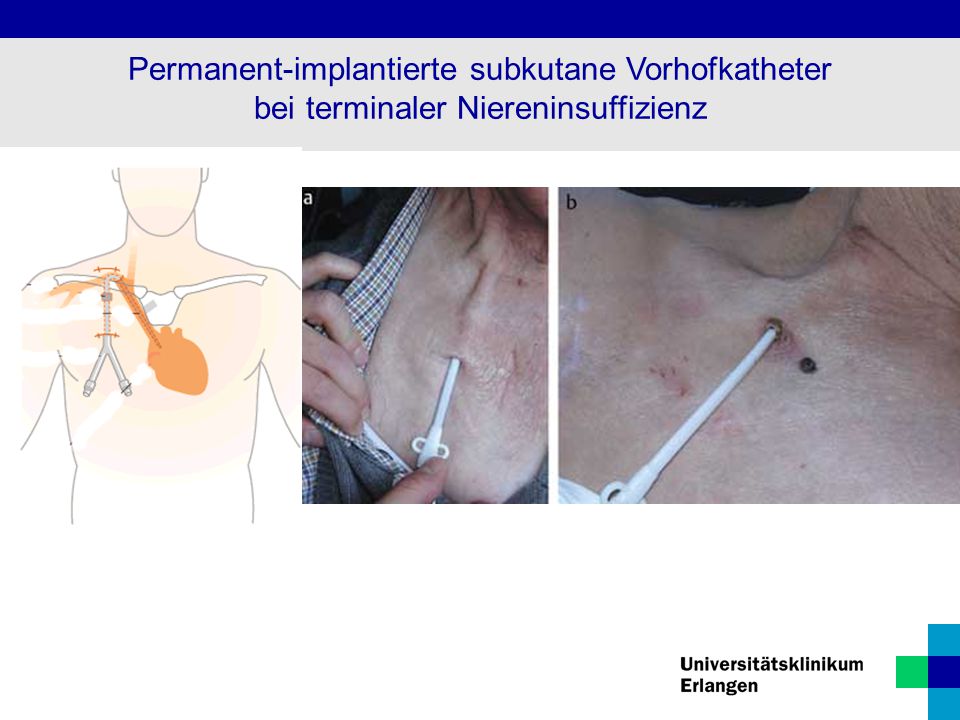 Permanent-implantierte subkutane Vorhofkatheter