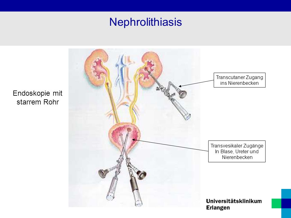 Nephrolithiasis Endoskopie mit starrem Rohr Transcutaner Zugang