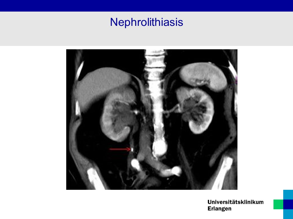 Nephrolithiasis