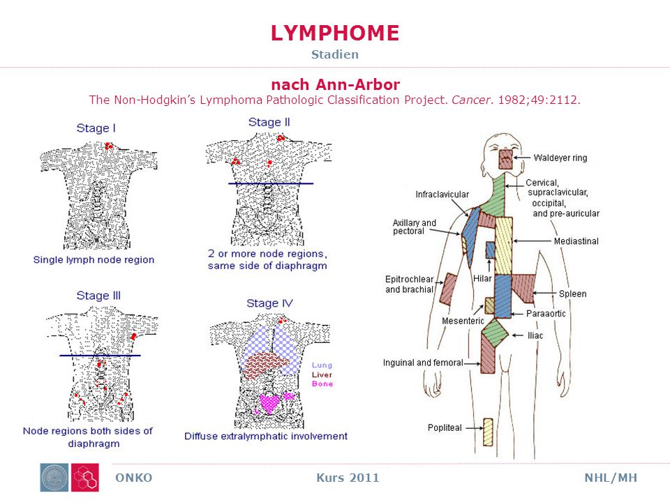 LYMPHOME Stadien nach Ann-Arbor The Non-Hodgkin’s Lymphoma Pathologic Classification Project. Cancer. 1982;49:2112.