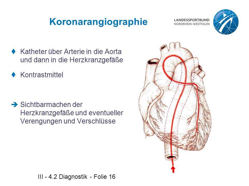 Koronarangiographie Katheter über Arterie in die Aorta und dann in die Herzkranzgefäße. Kontrastmittel.