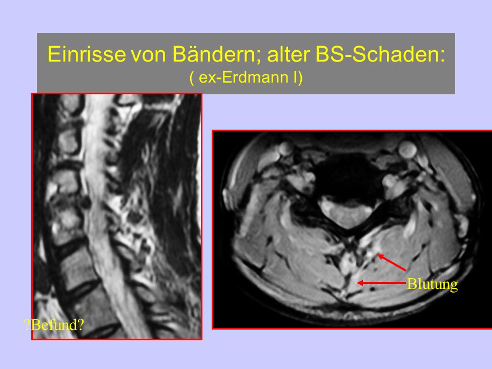 Einrisse von Bändern; alter BS-Schaden: ( ex-Erdmann I)