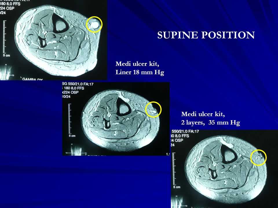 SUPINE POSITION Medi ulcer kit, Liner 18 mm Hg Medi ulcer kit,