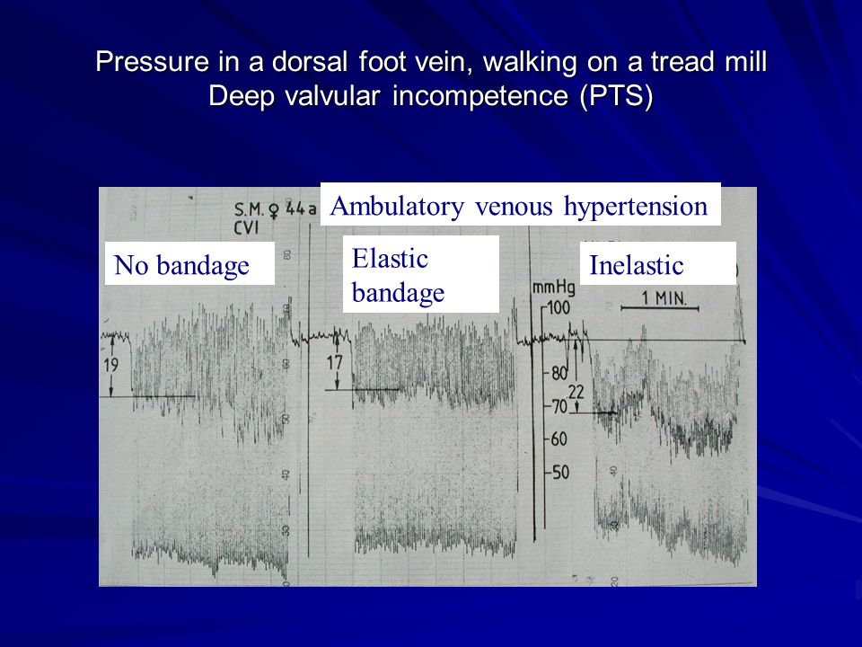 Pressure in a dorsal foot vein, walking on a tread mill Deep valvular incompetence (PTS)
