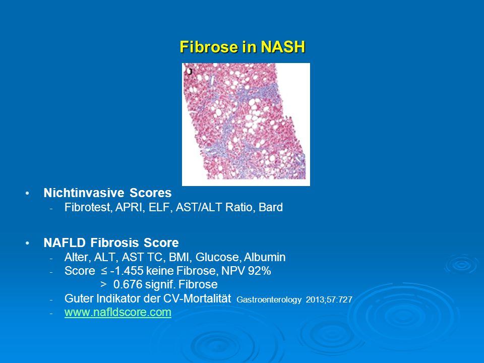 Fibrose in NASH Nichtinvasive Scores NAFLD Fibrosis Score