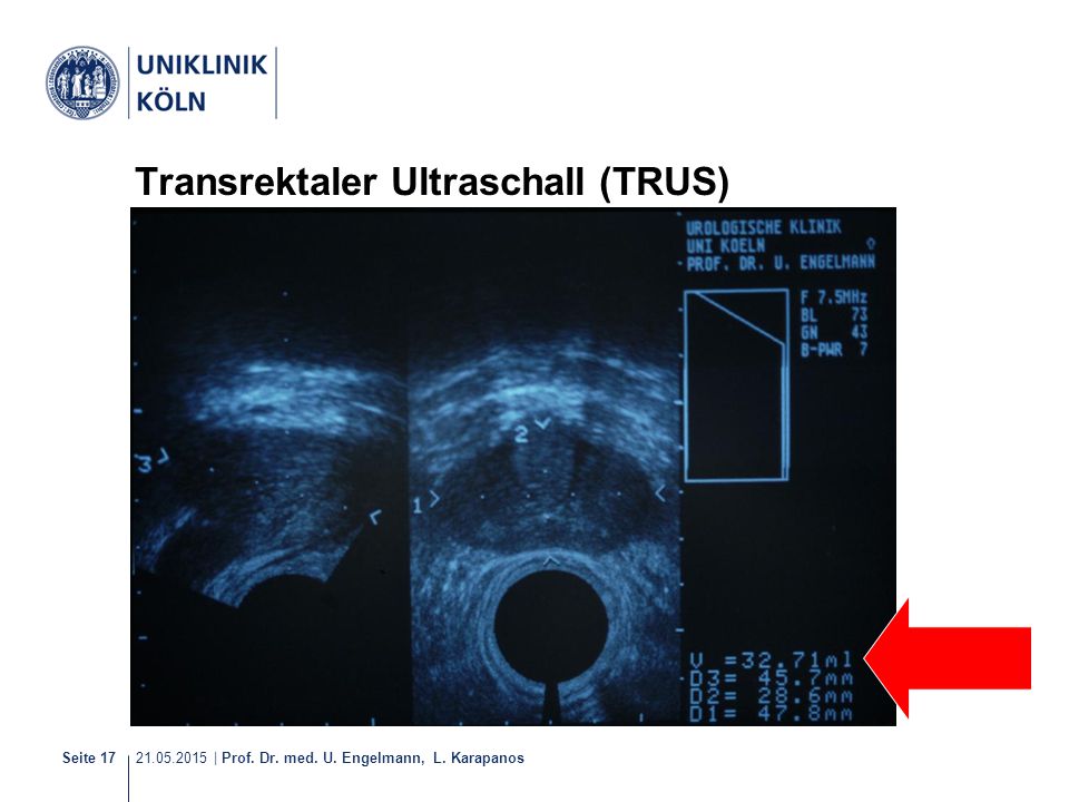 Transrektaler Ultraschall (TRUS)