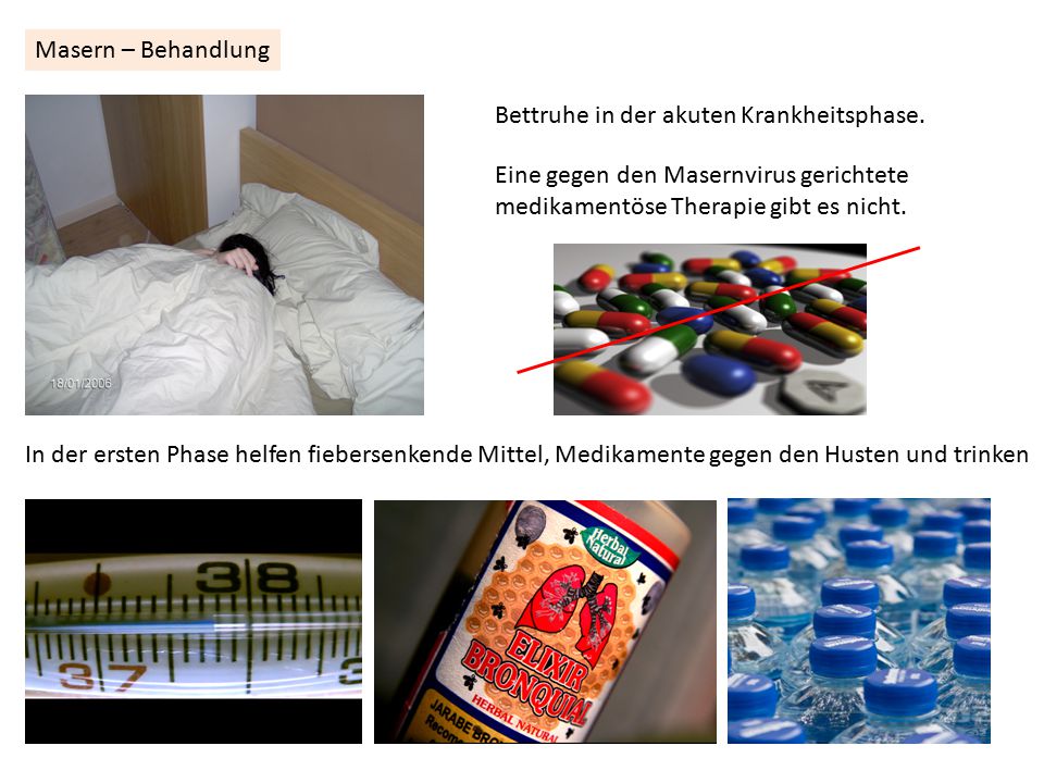 Masern – Behandlung Bettruhe in der akuten Krankheitsphase. Eine gegen den Masernvirus gerichtete.