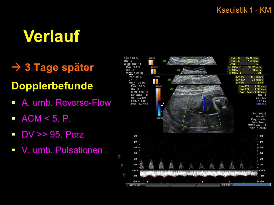 Verlauf  3 Tage später Dopplerbefunde A. umb. Reverse-Flow