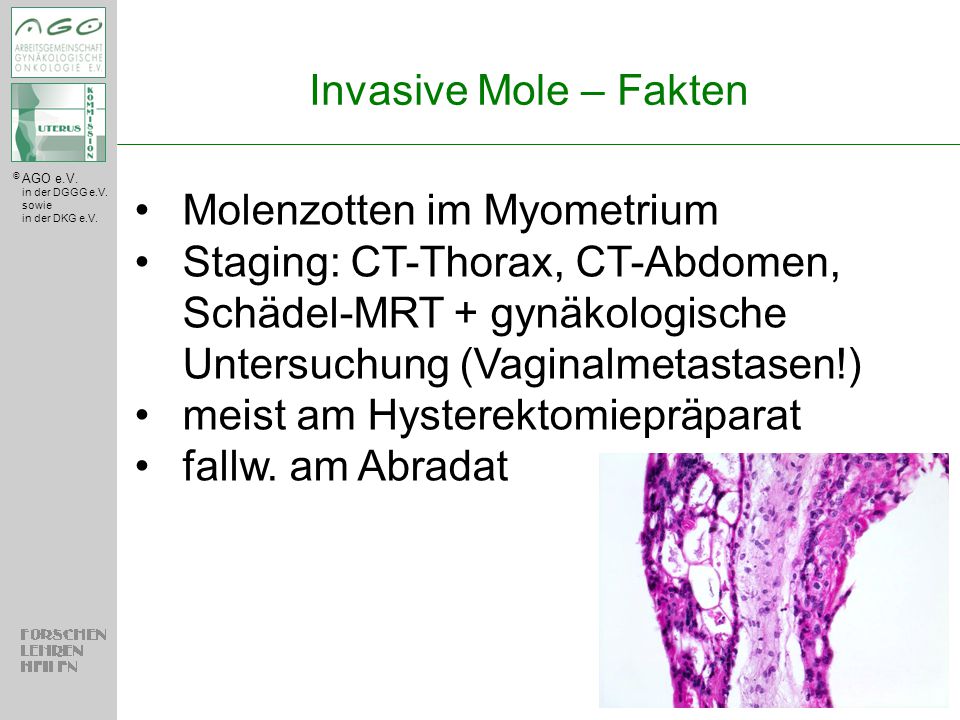 Invasive Mole – Fakten Molenzotten im Myometrium. Staging: CT-Thorax, CT-Abdomen, Schädel-MRT + gynäkologische Untersuchung (Vaginalmetastasen!)