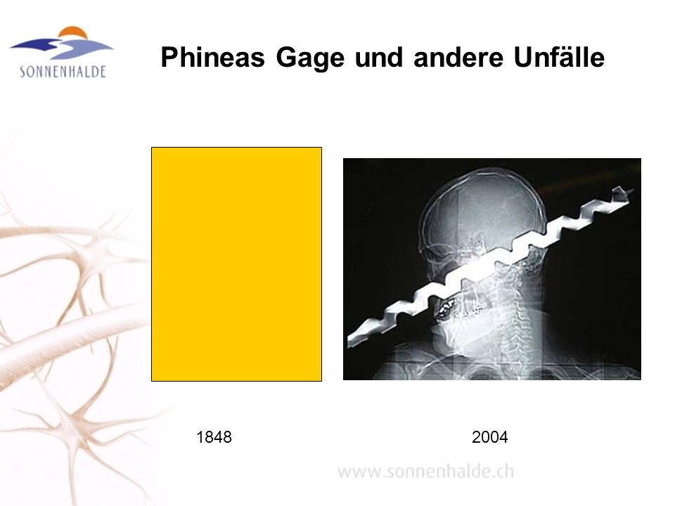 Phineas Gage und andere Unfälle