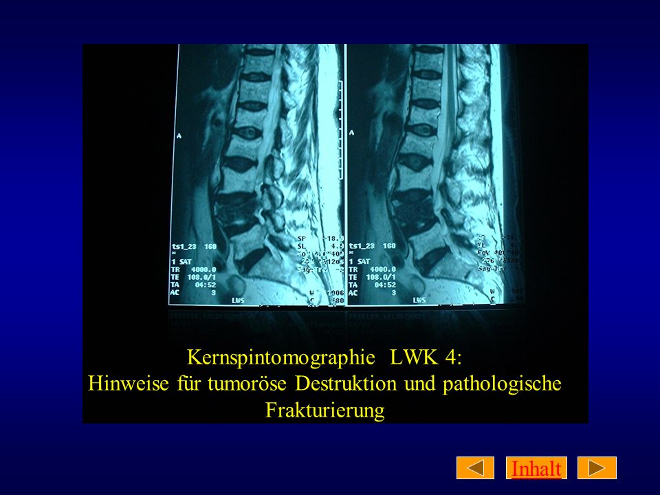 Kernspintomographie LWK 4: Hinweise für tumoröse Destruktion und pathologische Frakturierung