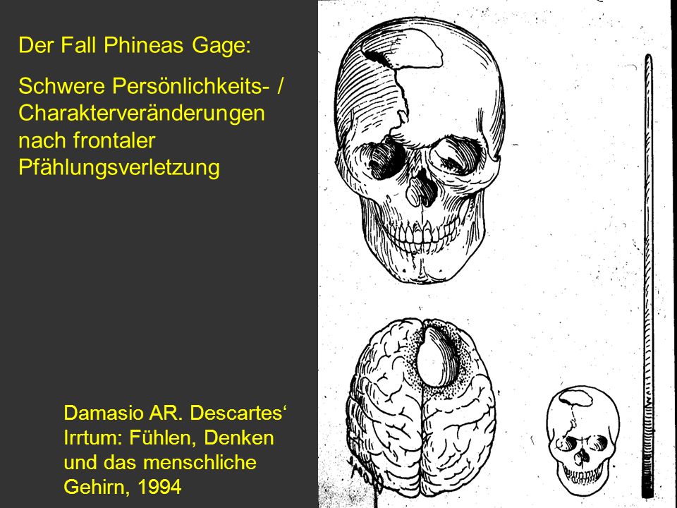 Der Fall Phineas Gage: Schwere Persönlichkeits- / Charakterveränderungen nach frontaler Pfählungsverletzung.