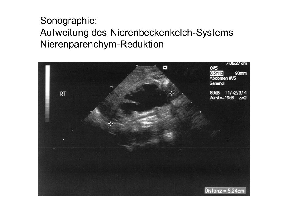Sonographie: Aufweitung des Nierenbeckenkelch-Systems Nierenparenchym-Reduktion