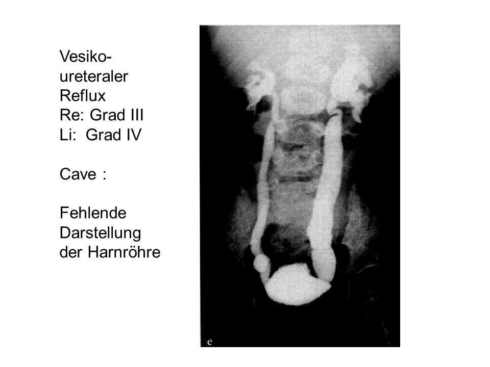 Vesiko- ureteraler Reflux Re: Grad III Li: Grad IV Cave : Fehlende Darstellung der Harnröhre