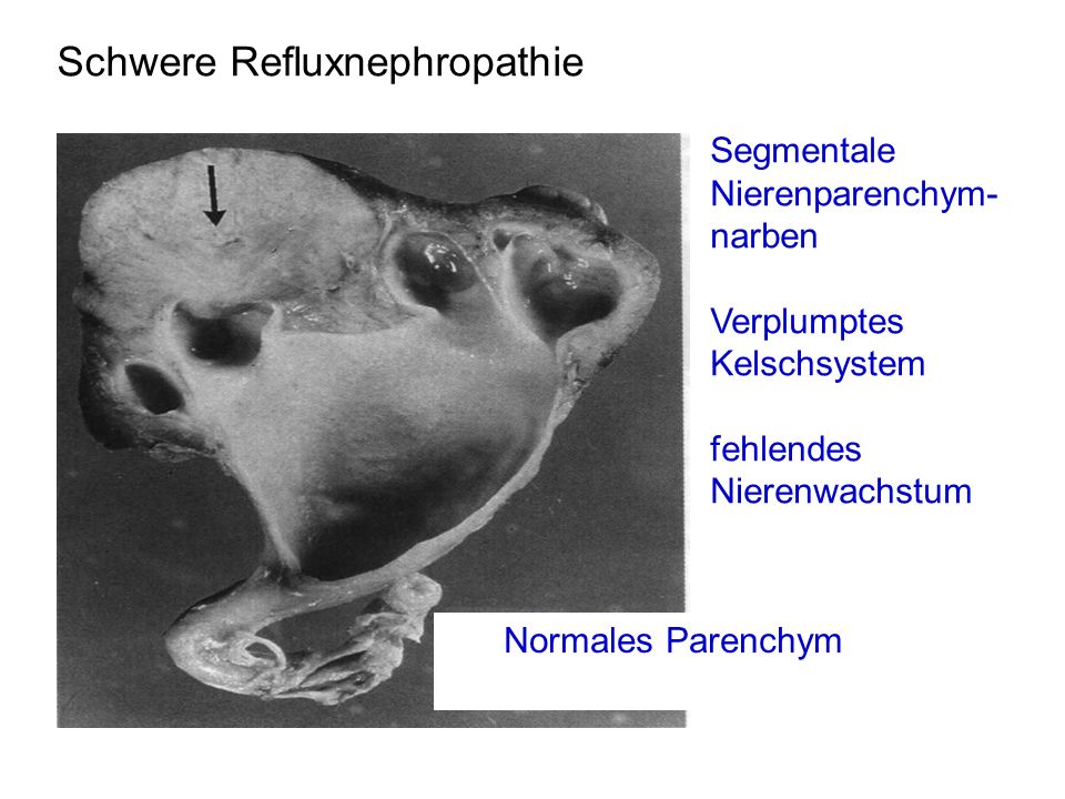 Schwere Refluxnephropathie