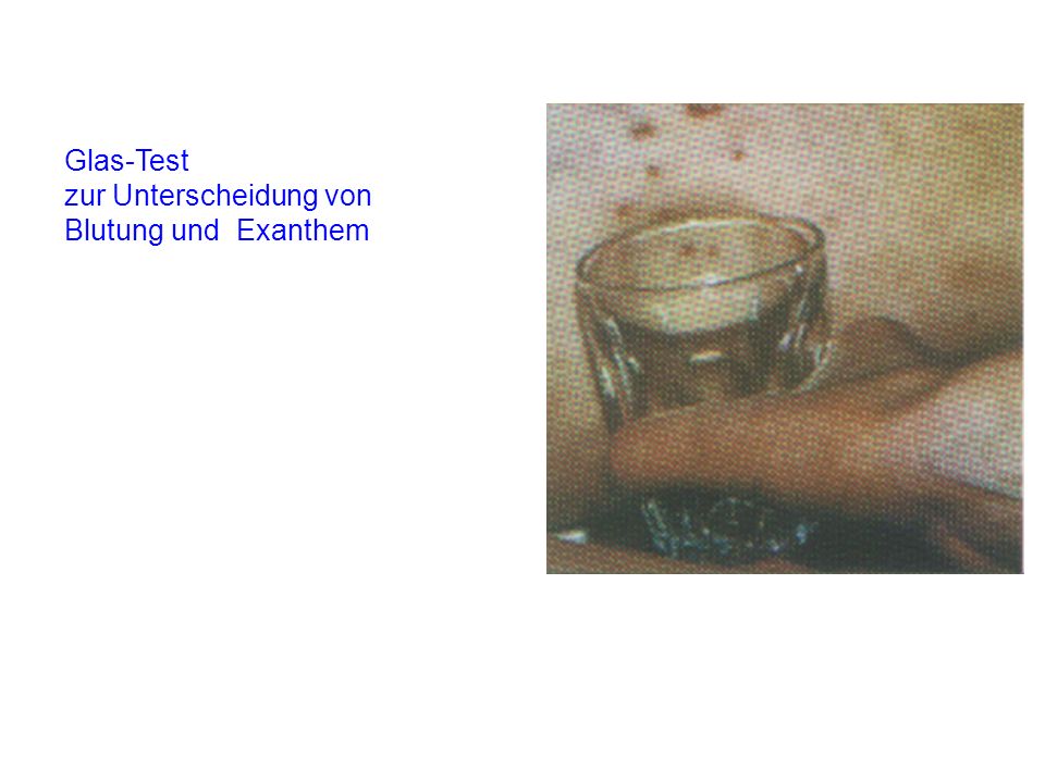 Glas-Test zur Unterscheidung von Blutung und Exanthem