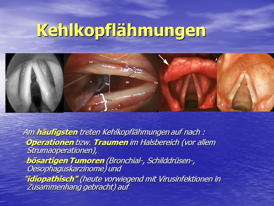 Kehlkopflähmungen Am häufigsten treten Kehlkopflähmungen auf nach : Operationen bzw. Traumen im Halsbereich (vor allem Strumaoperationen),