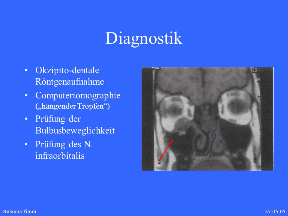 Diagnostik Okzipito-dentale Röntgenaufnahme