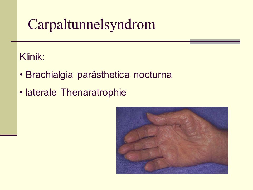 Carpaltunnelsyndrom Klinik: Brachialgia parästhetica nocturna