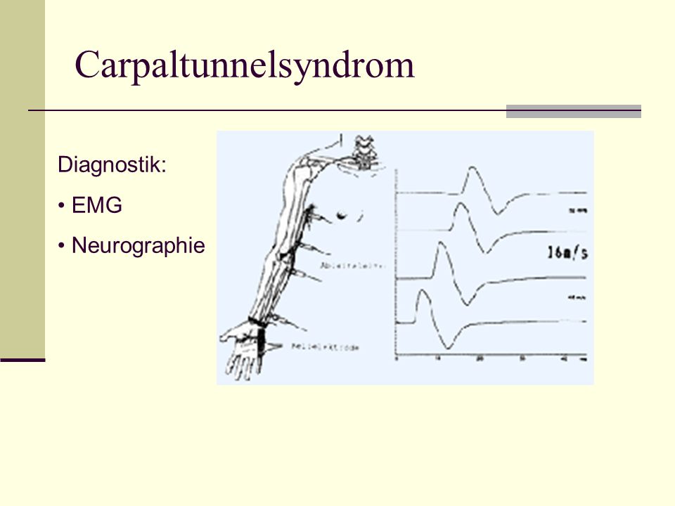 Carpaltunnelsyndrom Diagnostik: EMG Neurographie
