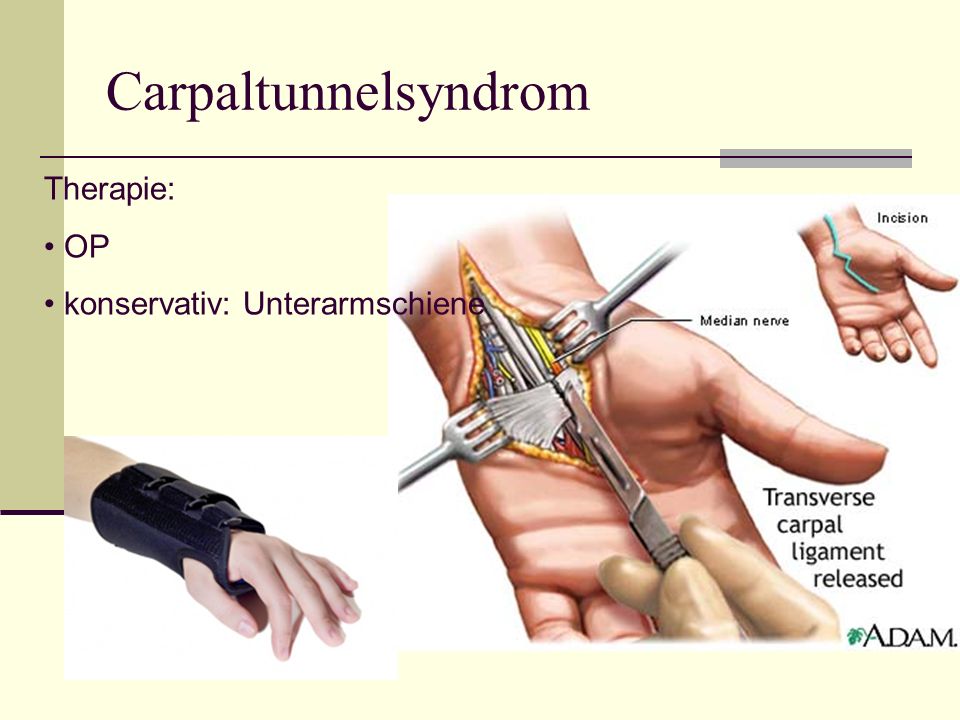 Carpaltunnelsyndrom Therapie: OP konservativ: Unterarmschiene