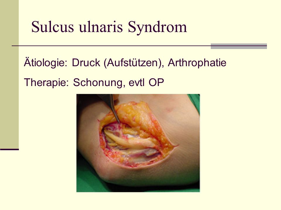 Sulcus ulnaris Syndrom