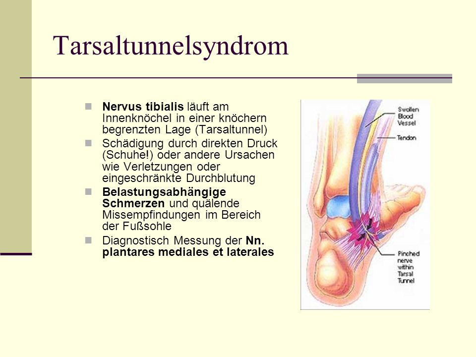 Tarsaltunnelsyndrom Nervus tibialis läuft am Innenknöchel in einer knöchern begrenzten Lage (Tarsaltunnel)