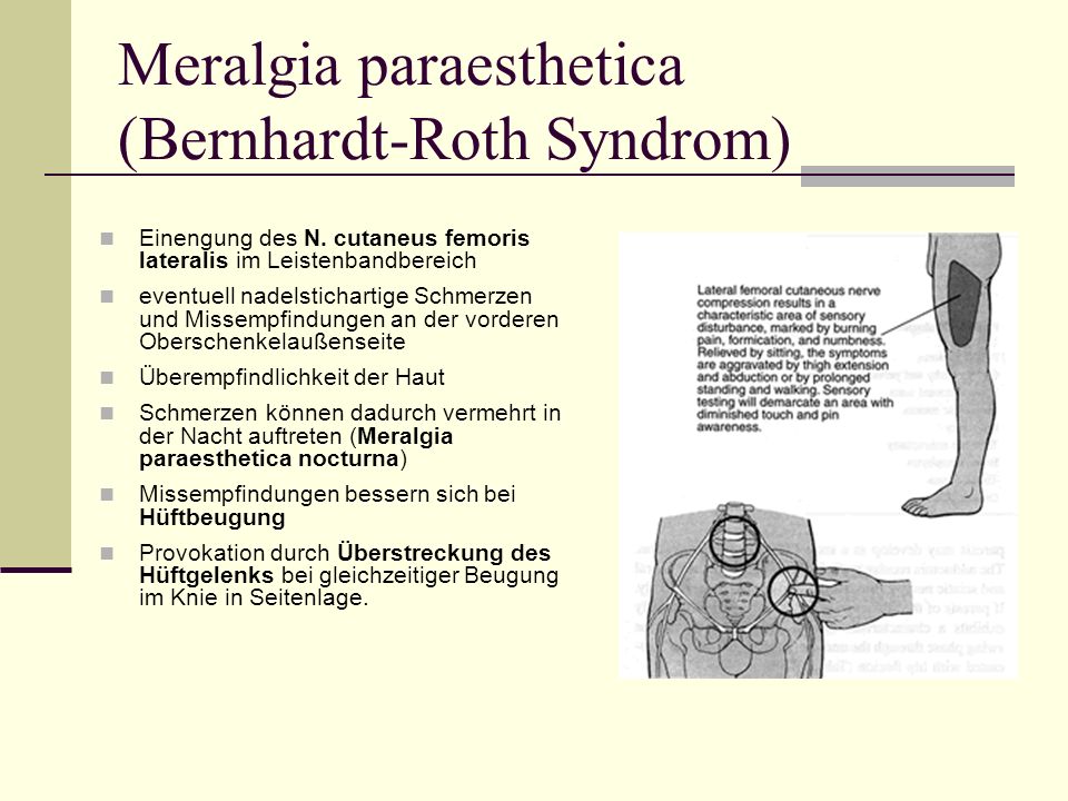 Meralgia paraesthetica (Bernhardt-Roth Syndrom)