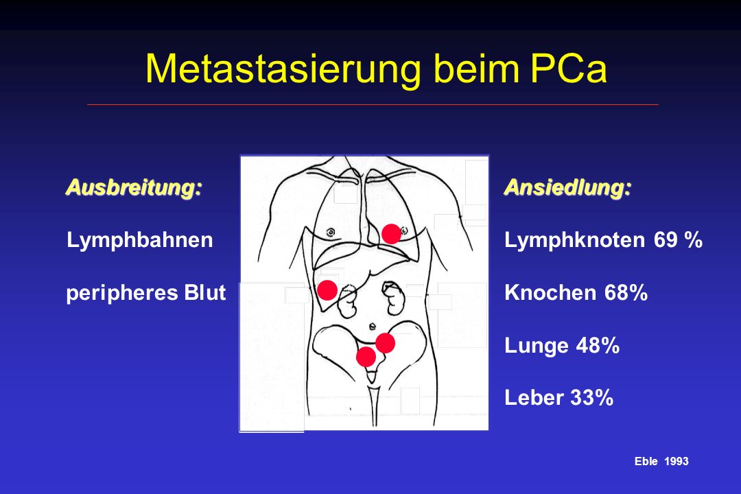 Metastasierung beim PCa