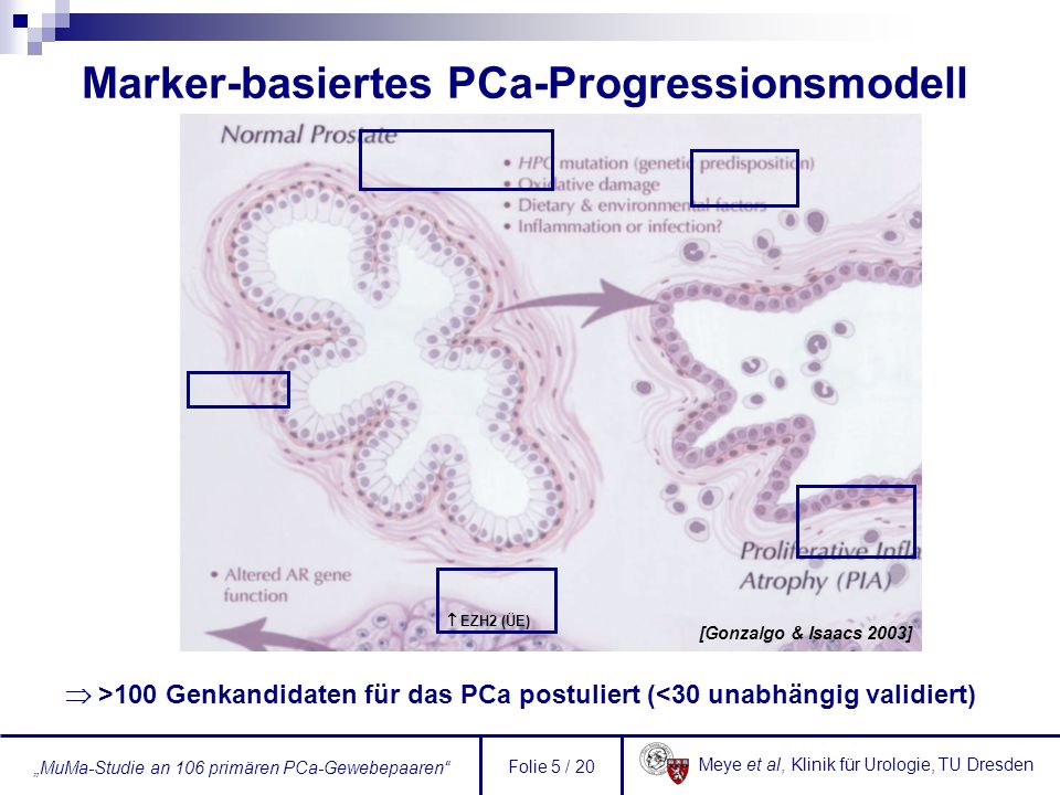 Marker-basiertes PCa-Progressionsmodell