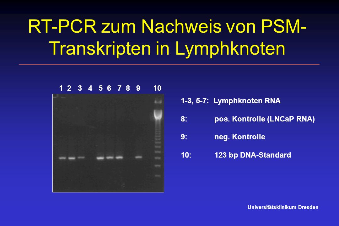 RT-PCR zum Nachweis von PSM-Transkripten in Lymphknoten