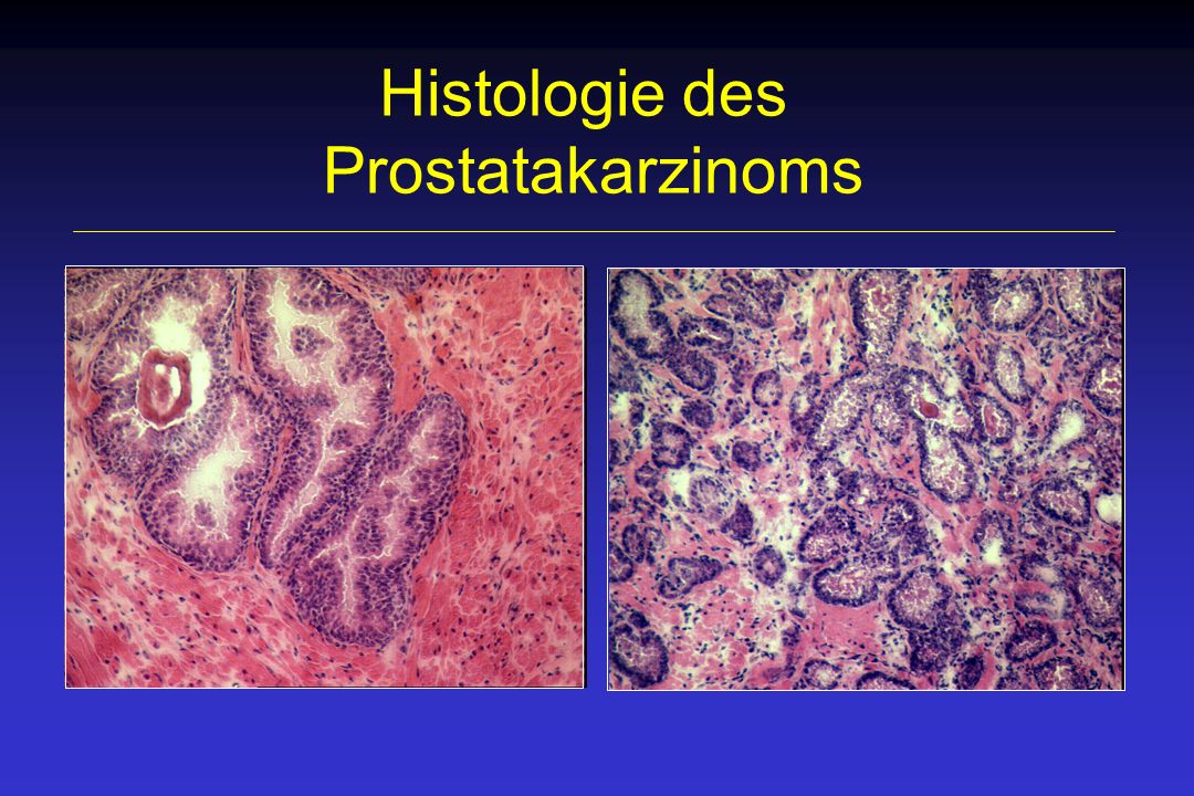 prostatakarzinom histologie