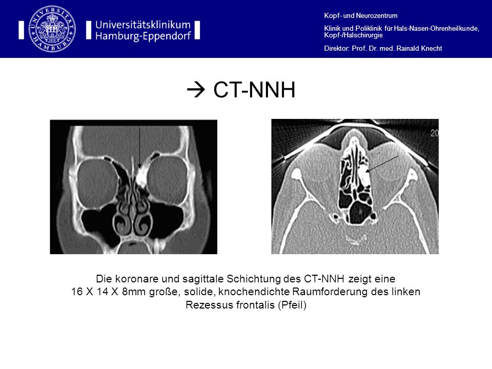 Die koronare und sagittale Schichtung des CT-NNH zeigt eine