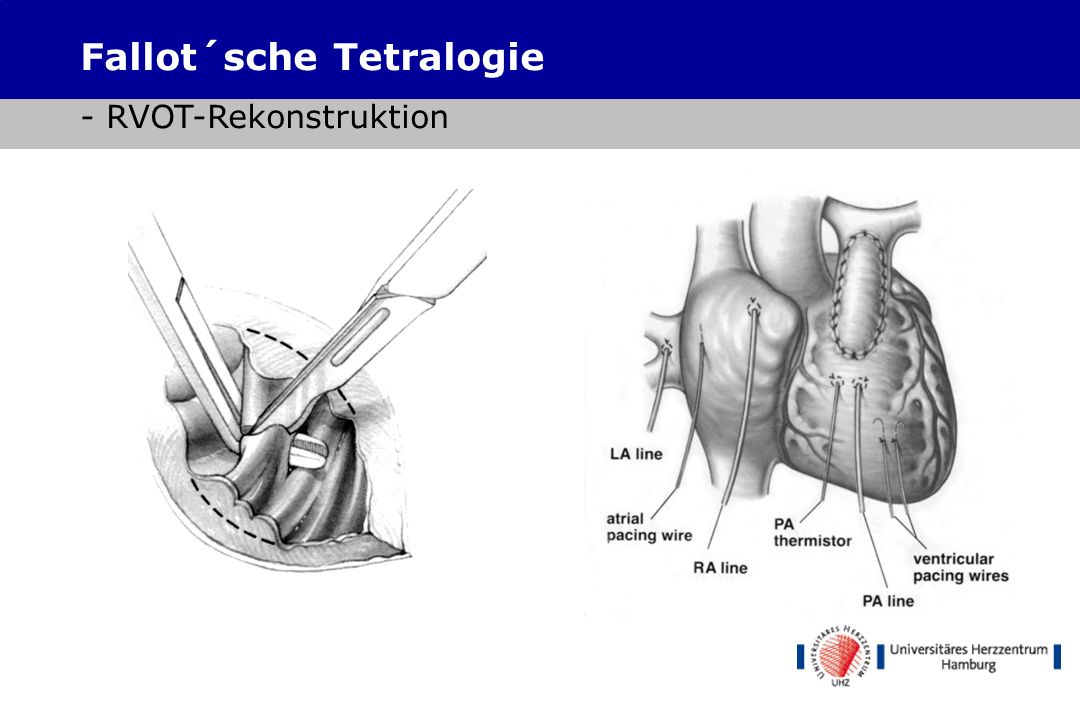 Fallot´sche Tetralogie - RVOT-Rekonstruktion