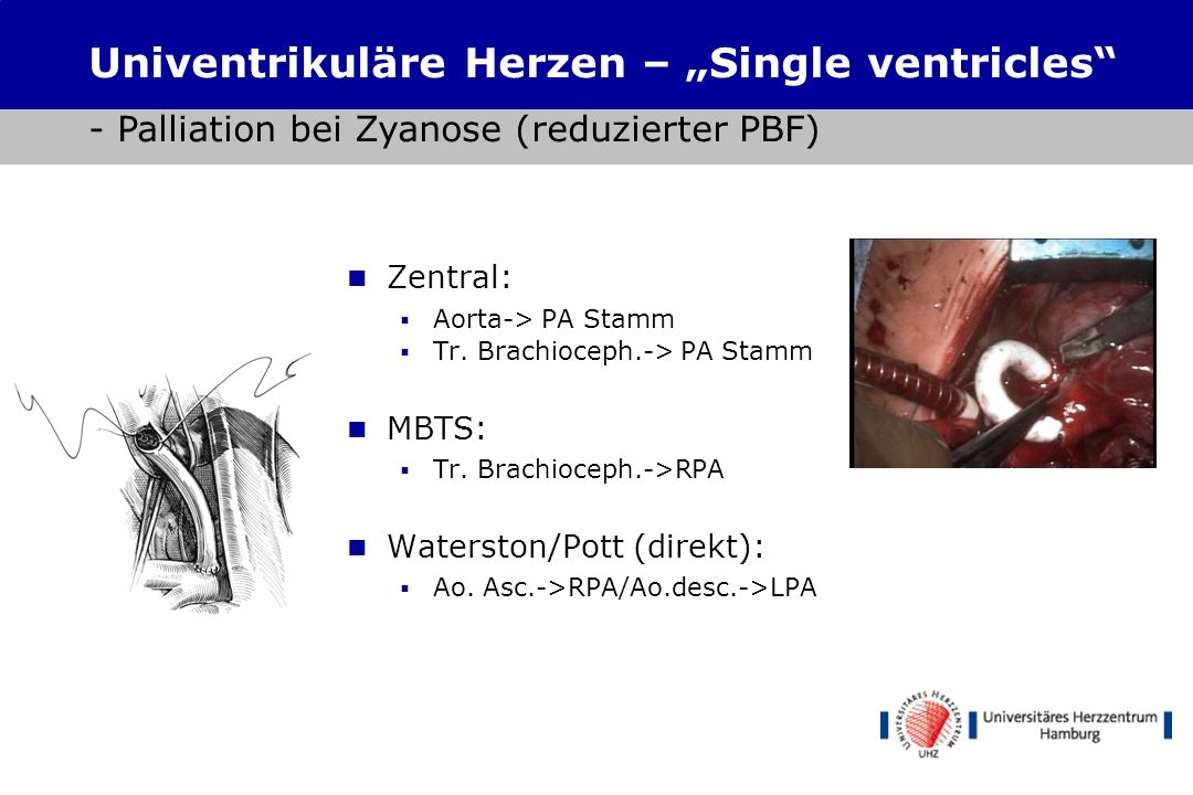 Shunts Univentrikuläre Herzen – „Single ventricles - Palliation bei Zyanose (reduzierter PBF) Zentral: