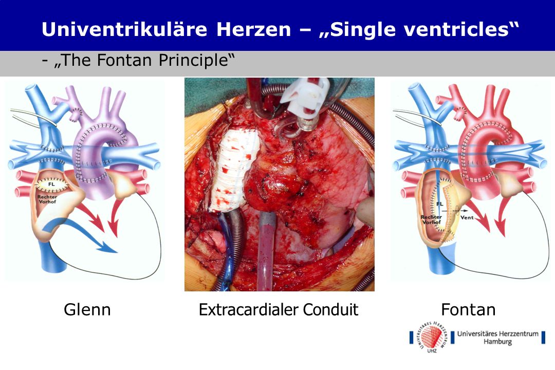 Univentrikuläre Herzen – „Single ventricles - „The Fontan Principle
