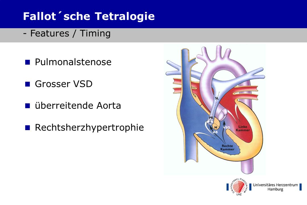 Fallot´sche Tetralogie - Features / Timing