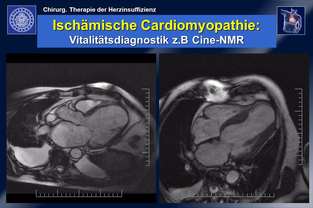 Ischämische Cardiomyopathie: Vitalitätsdiagnostik z.B Cine-NMR