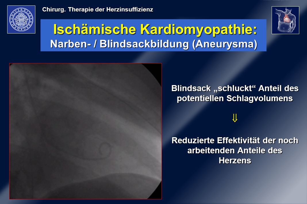 Ischämische Kardiomyopathie: Narben- / Blindsackbildung (Aneurysma)