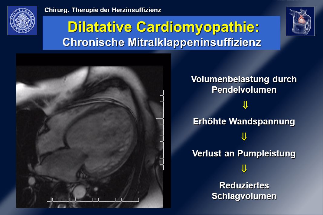 Dilatative Cardiomyopathie: Chronische Mitralklappeninsuffizienz
