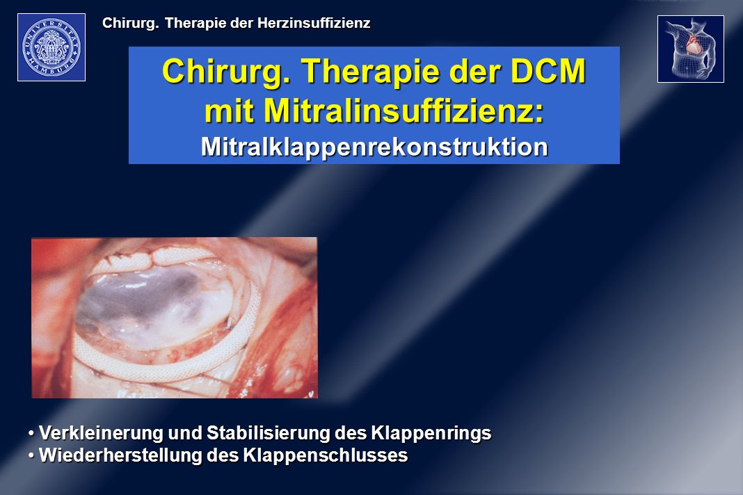 Chirurg. Therapie der DCM mit Mitralinsuffizienz: Mitralklappenrekonstruktion
